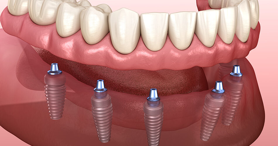 all-on-6-dental-implants-Turkey