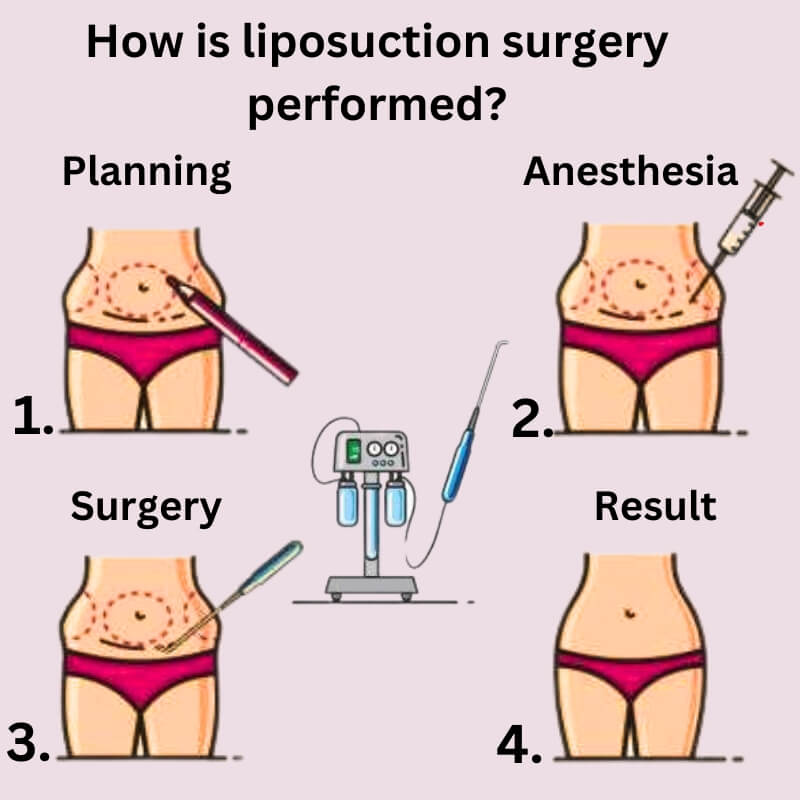 How is liposuction surgery performed?